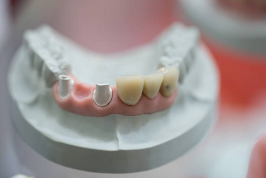 Renaissance du Sourire : La Magie des Implants Dentaires avec Metior